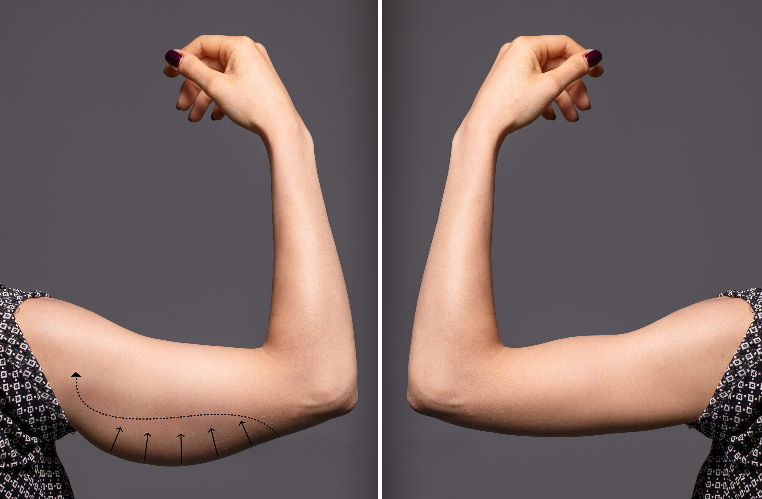 Woman arms with bat wings, comparison between before and after brachioplasty surgery